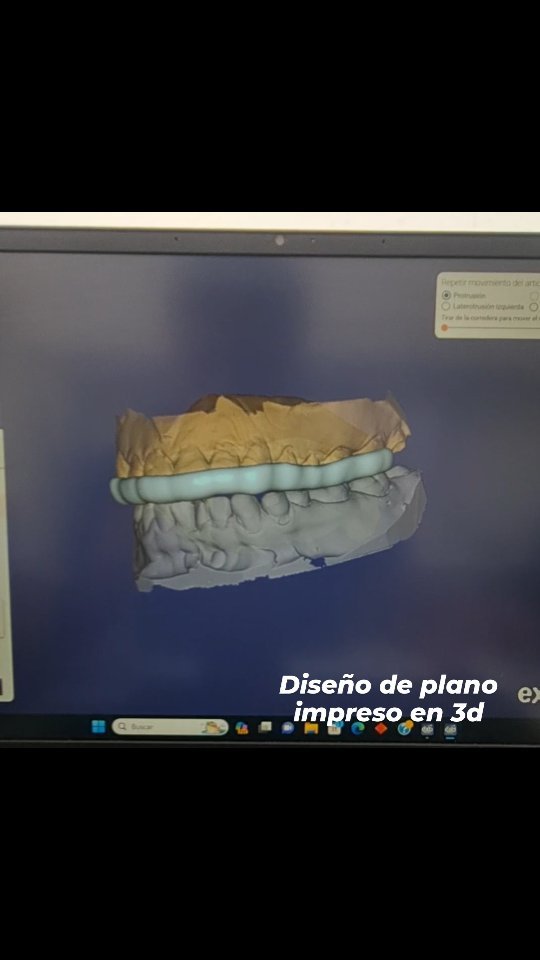 Diseño digital de férula oclusal superior, la cual posteriormente fue impresa en una resina dental transparente especial en una impresora dental 3d, se puede utilizar en pacientes con bruxismo de sueño, en tratamiento de molestias musculares y articulares, en este caso se utiliza para protección de una rehabilitación realizada con resina compuesta.