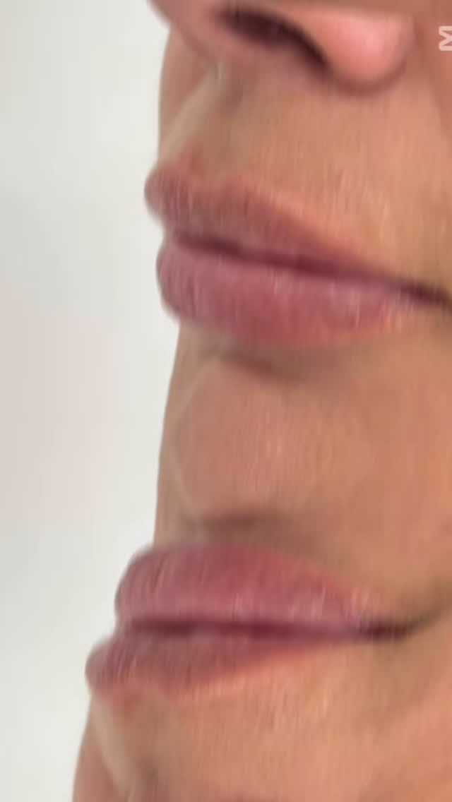 💋💋It’s been a Lip heavy day and so many lovely results! 💋💋
A juicier, more hydrated, plump finish here.
💉Using @teoxane_uk RHA KISS.
If you want to see more DM : LIPS.
📸 Taken immediately after treatment
❤️ Instantly loved them
#medicallytrained #winchester #skin #hampshire #lips #lipboss #plump #summervibes☀️
@teoxane_uk