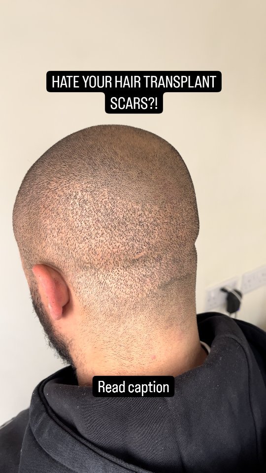TRANSPLANT SCARS
Even with excellent hair transplant results you are often left with unsightly scars at the donor area
If you want a skin fade these are often visible and a tell tale sign you have had a transplant
Even footballers often grow their hair out at the back to hide them
FYI- this was a 'scarless' FUE transplant and can often be Even worse if they have over harvested the donor area
I have personally suffered this and grateful for Scalp Micro-Pigmentation (SMP)
📍Bury St Eds, Suffolk & Brighton, UK
#scalpmicropigmentation #smp #scarcamouflage #hairtransplant #hairtransplantistanbul #hairtattoo #barber #menshair #scar #cosmetictattoo
