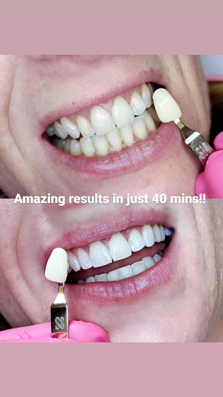 Teeth whitening 😁amazing results in just 40 min😍can’t believe ? Come and try it 😎