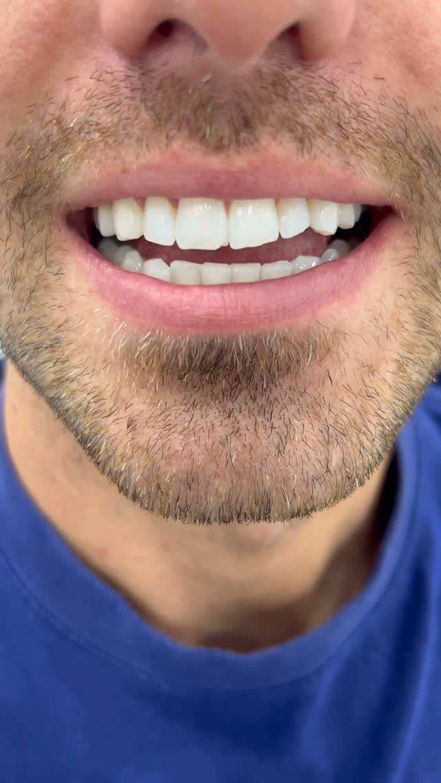 Keep your teeth healthy with Composite bonding at Teeth by Teki #teethbyteki #compositebonding #smilemakeover