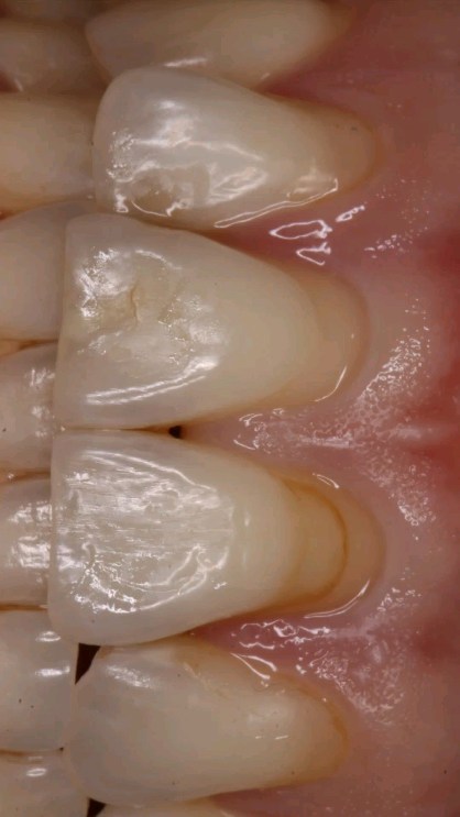 Carillas de resina compuesta.
Corrección estética de desgastes cervicales y recambio de restauraciones antiguas.
TIENES ALGO SIMILAR?
AGENDA TU EVALUACIÓN!