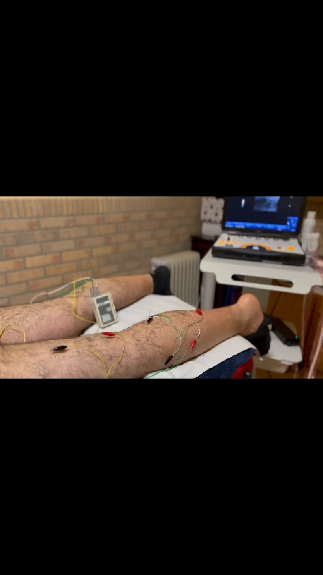 Neuromodulación ecoguiada del nervio ciático y sus ramificaciones en CPE y CPI.
#fisioterapia #ecografia #neuromodulacion #neuropatia #ciatica #fisioinvasiva