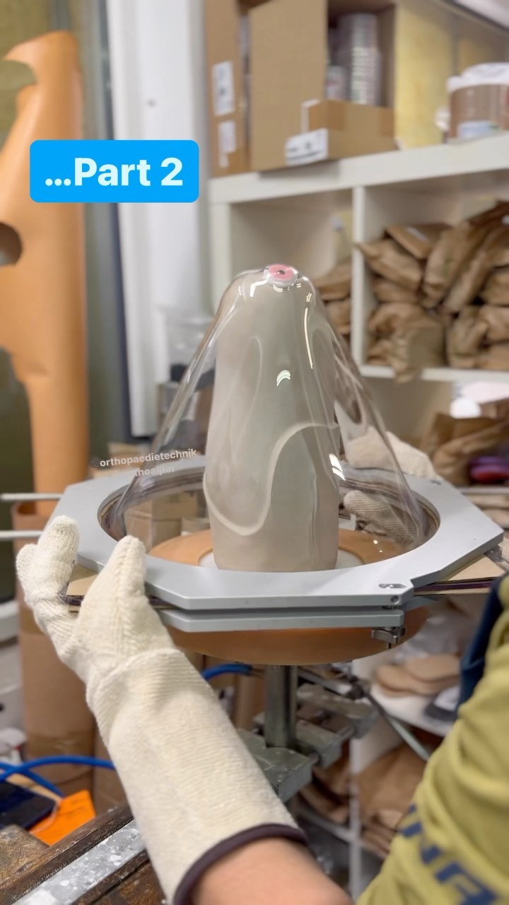 Teil 2 - Innenschaft, Armierung und Harzverarbeitung
Tiefziehen des Innenschaftes. Das erste mal für mich mit dem Infrarotofen. Ok ich gebe es zu. Dieses war die 3. Platte PETG 5mm 🙈. (Vielleicht gibt’s noch ein outtake-Video 😅)
Bei diesem Schaft war Hautfarbe gewünscht. Mag ich persönlich nicht so sehr, da es mehr Gewicht bringt durch die zusätzlichen Perlon-Lagen. Ansonsten: 1.Guss nur ein C-Flechtschlauch und bisserl UD-Band im Anschlussplattenbereich und an anderen wichtigen Stellen. Menge je nach Aktivitätsgrad und Gewicht des Anwenders.
Als Harz nehme ich immer Polypox. Gemischt mit Polypox Speed, für eine kürzere Topfzeit. (Zeit ist Geld☝️😅)
🇬🇧 part2 - pulling the inner-socket, carbon layers and resin works.
It was my first time using my infrared-oven for the 5mm PETG-inner socket. It took me 3 attempts 🙈
The customer preffered a skin colored socket (which I don’t like pretty much since it has more eight due to the perlon-layers).
So it has 2 Perlon layers, 1 carbon fabric tube and some uni-directional carbon fabric tape.
For resin I prefer the Polypox mixed with Polypox speed for faster hardening.
#orthoalpin
#orthopädietechnik #oandp #unterschenkelprothese #prosthesis #belowkneeprosthesis #prothese #prosthetics #beinprothese #carbon #resin #harz #prostheticleg #amputiert #amputee #amputeelife #lifestylemedicine #handwerk #handmade #handcrafted #polypox #handarbeit #immerweiter #lustaufhandwerk #custommade #meinhandwerkhilft