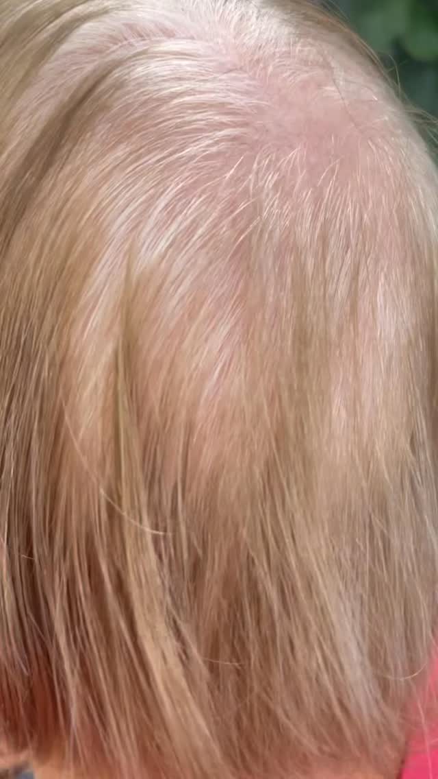 #hairreplacementsystem #hairtransformation by @thehavensydney DM us for a private consultation #hairloss #alopecia #hairwigs #hairtopper