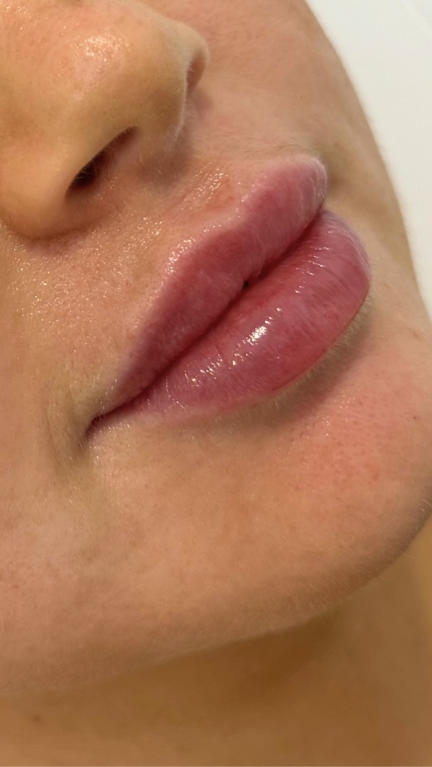 ✨ WE ARE BACK BABY✨
Beautiful client wanting hydration and volume in her lips💕
Please Note: After video taken straight after treatment. Swelling present.
Video shared with clients consent 💕
If you’re considering injectable treatments, reach out for a complimentary consultation to explore the exciting possibilities I can offer you!
.
.
.
.
.
.
.
.
.
.
.
.
.
.
#cosmetics #cosmeticnurse #beauty #lipfiller #confidence #cosmeticinjector #dermalfiller #injectables #ilovetaupo #barebeautyaesthetics