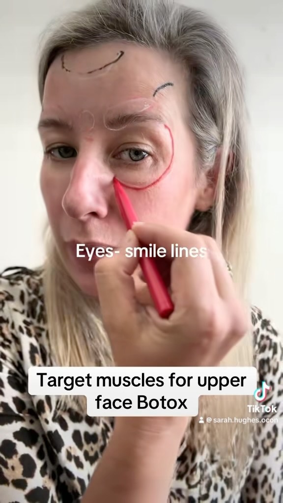 These are the muscles we target in upper face Botox to reduce dynamic lines & wrinkles. This is the most common treatment I do at drsarahhughes. Click the link in bio to book your consultation. #upperfacebotox #facialaestheticslondon #lookyoungerfeelbetter #threeareasbotox #aestheticdoctorlondon