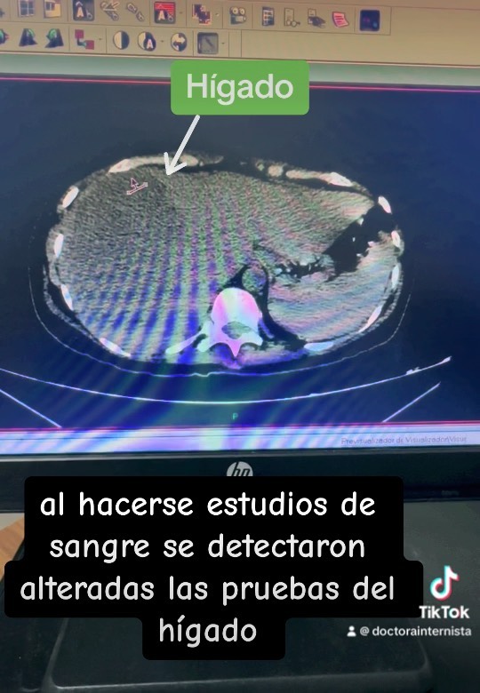 Hombre 19 años con fiebre y malestar general 2 semanas + pruebas de función del hígado alteradas. #internista #higado