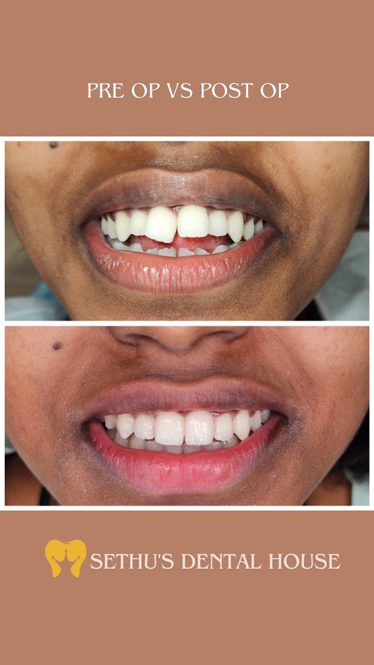 Treatment of anterior open bite with self ligating fixed braces system.
Passion for orthodontics is because of results like these.
Precise , Pleasant and Aesthetic Dentistry
Sethu's Dental House
For queries - 9789247362, 04442137362
#orthodontics
#braces #orthodontist #dentistlife #dentist #chennai #chrompet #sethusdentalhouse