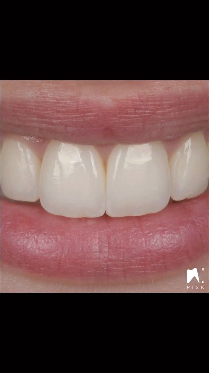 Just layering & injection.
Here no space to complete layering. So apply dentin at the top and stain it.
Here just white stain was apply. Take attention to apply white at the 2 angles, not only at the incisal edge.
Material : GUI AE, JE and gaenial achord OA1 and A1 from GC, white stain, ivoclar
Lovely texture. 🤌
#minimalivasivedentistry #biomimeticdentistry #rubberdam #rubberdamology #nictone #nictonerubberdam #compositebonding #prosthodontics #prosthodontist #directcomposite #estheticdentistry #identistry #dentistryworld #restaurativedentistry #dentalphotography #dentist #dental #facette #veneer