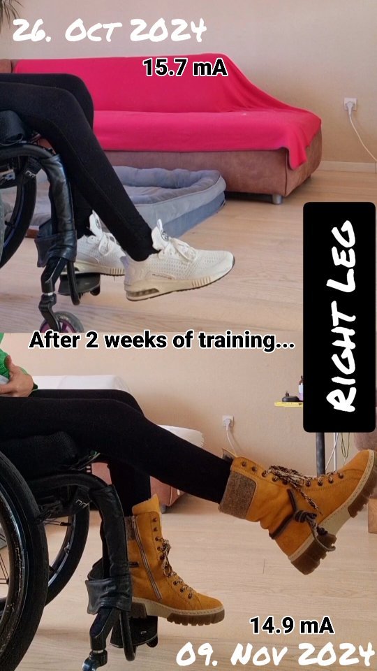 This video shows the progress of 2 weeks muscle stimulation despite a complete spinalcordinjury. Possible because of an implanted pacemaker connected to the pelvic nerves (by Lion-Procedure).
The stimulation could be decreased from 15.7 mA (Milliampere) to 14.9 mA but with better result in degree and time of extension.
.
#spinalcordinjury #lionprocedure #wheelchair #nevergiveup #fight #rausausdemrollstuhl