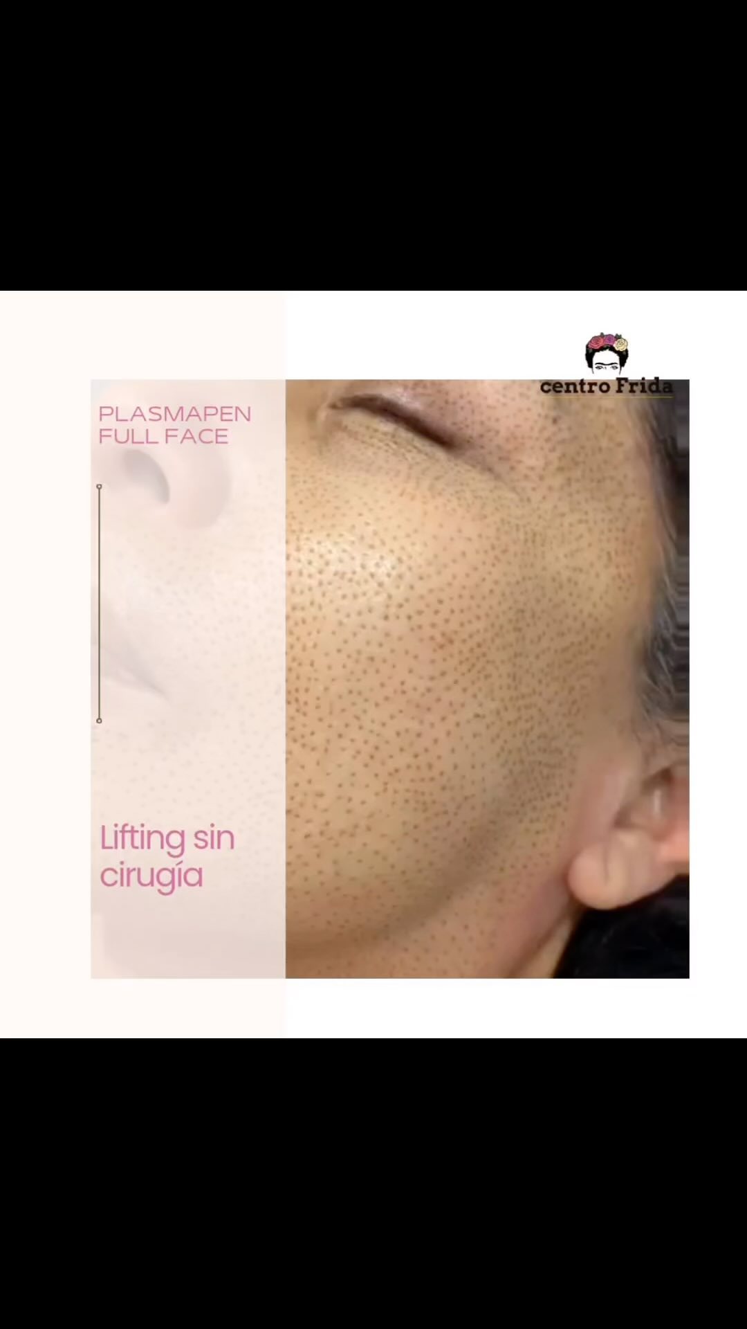 ¿Estás buscando una forma efectiva de rejuvenecer tu piel sin necesidad de cirugía? ¡Entonces es hora de descubrir el Plasmapen! 🌸
Este tratamiento de lifting sin cirugía está diseñado para ofrecerte resultados sorprendentes, mejorando la textura y firmeza de tu piel de manera segura y eficaz.
En Centro Frida, este mes tenemos una oferta especial: ¡10% de descuento en tu tratamiento de Plasmapen! Es la oportunidad perfecta para darte ese capricho que tanto mereces y lucir una piel radiante.
No dejes pasar esta oportunidad y agenda tu cita en Centro Frida.
¡Te esperamos para que descubras tu mejor versión! 🌟
Centro Frida
Estética & Belleza 🌸
📲 624252194
••••••••••••••••••••••••
#plasmapenmadrid #dermapenmadrid #esteticamadrid #microblading #microbladingmadri #plasmapencuello #dermapenmadrid #presoterapiacorporal #maderoterapiamadrid