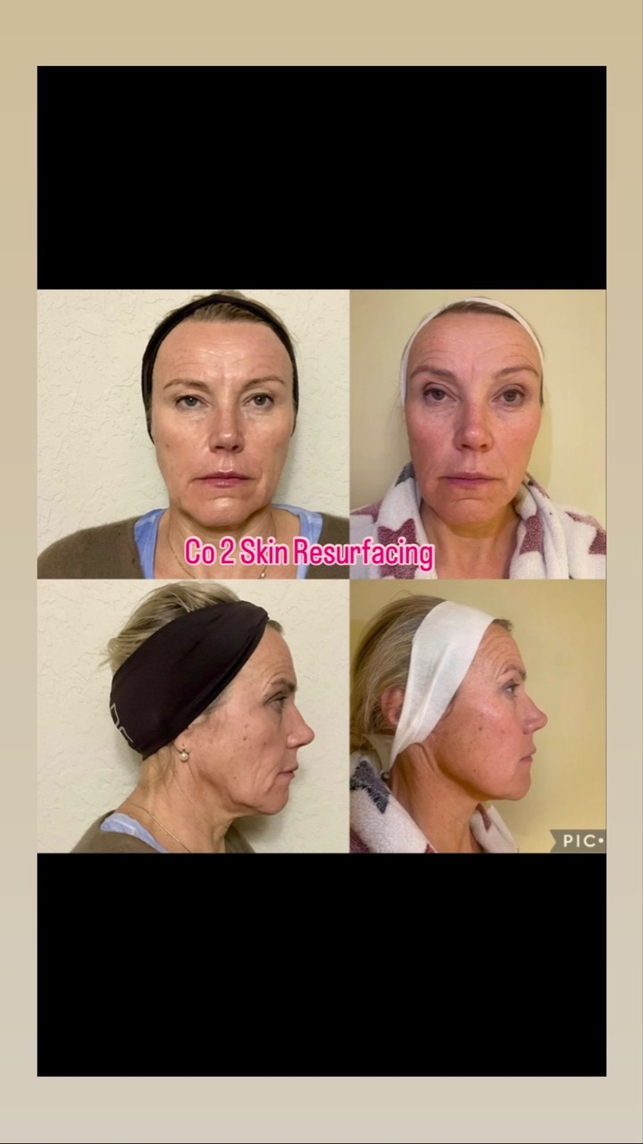 “Healing is still ongoing, but there’s already a noticeable difference after just 10 days.”#capricebeautybar #theskingames2024 #age #tampabay #sarasotaflorida #medspa #co2laser #sarasotaflorida #lolahodges #siberianbeautyskin #stpeteflorida #napelsflorida ‼️