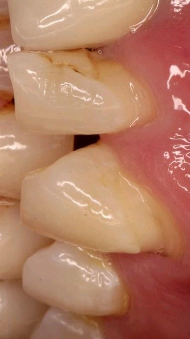 Cierre de espacios con resina compuesta y recambio de restauración filtrada, resultados en 1 sesión, resina tetric n-ceram @ivoclar