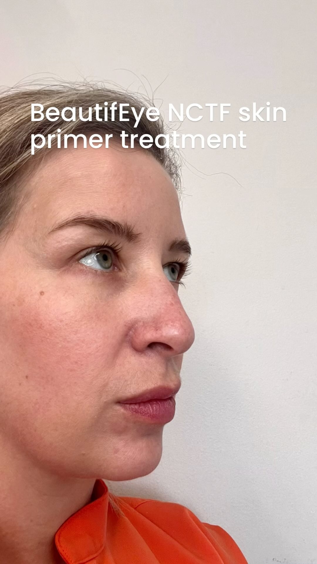 Want to do a skin rejuvenation treatment to tackle dark circles, eye bags & lax skin around your eye but worried about the procedure & downtime. The last photo shows me straight afterwards. I did the school run 45 mins after with no make up. No one noticed! #nctf #beuatifeye #nanosoft #undereyerejuvenation #skinboostertreatment #skinboosters #injectablesdowntime