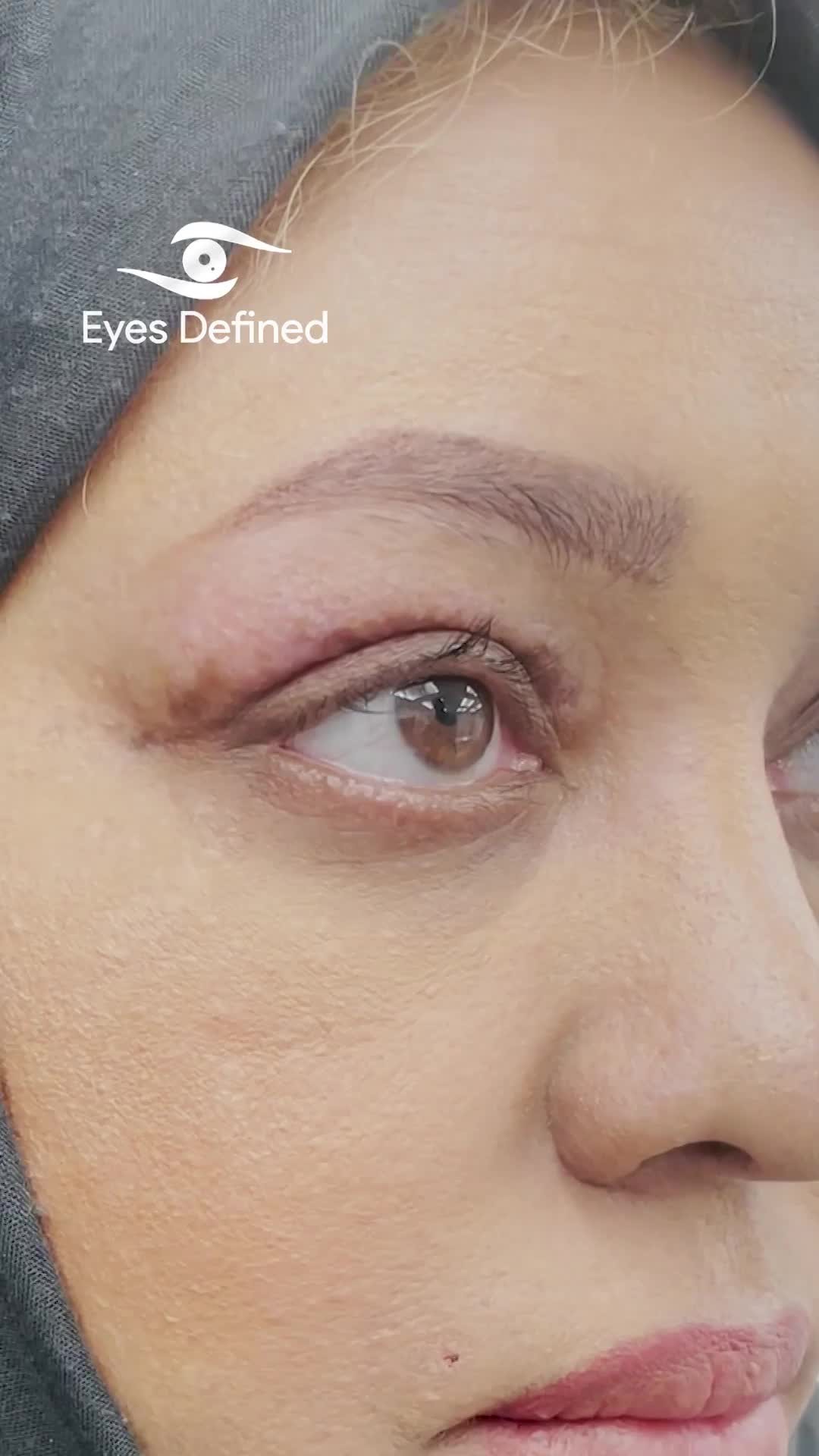 Blepharoplasty in the wrong hands can go wrong. This lady had some very unfortunate scarring following her first procedure and came to me for help. The challenge was to remove the scar in a natural looking way whilst allowing enough skin for good eyelid closure. I think we managed it here but this goes to show seek out an oculoplastic surgeon from the start #oculoplasticsurgeon #revisionblepharoplasty #eyelidsurgery #eyelidscar