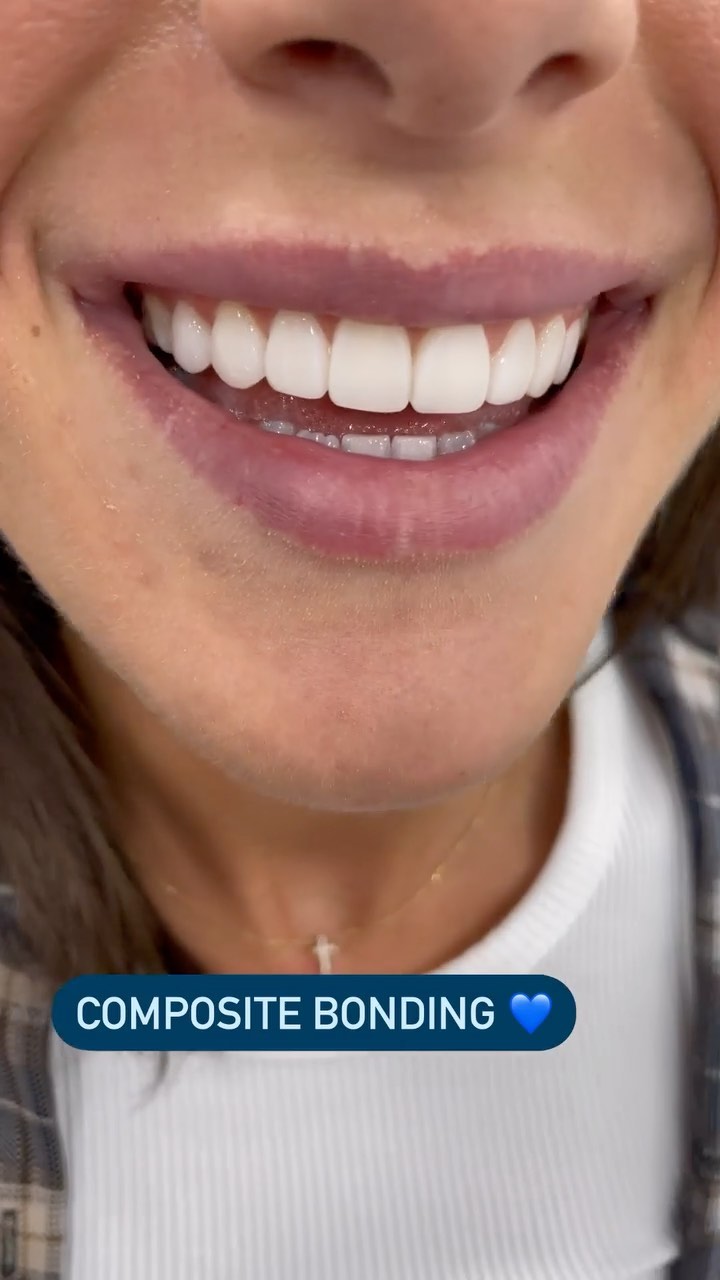 No drilling, no injections that’s why I love composite bonding 💙