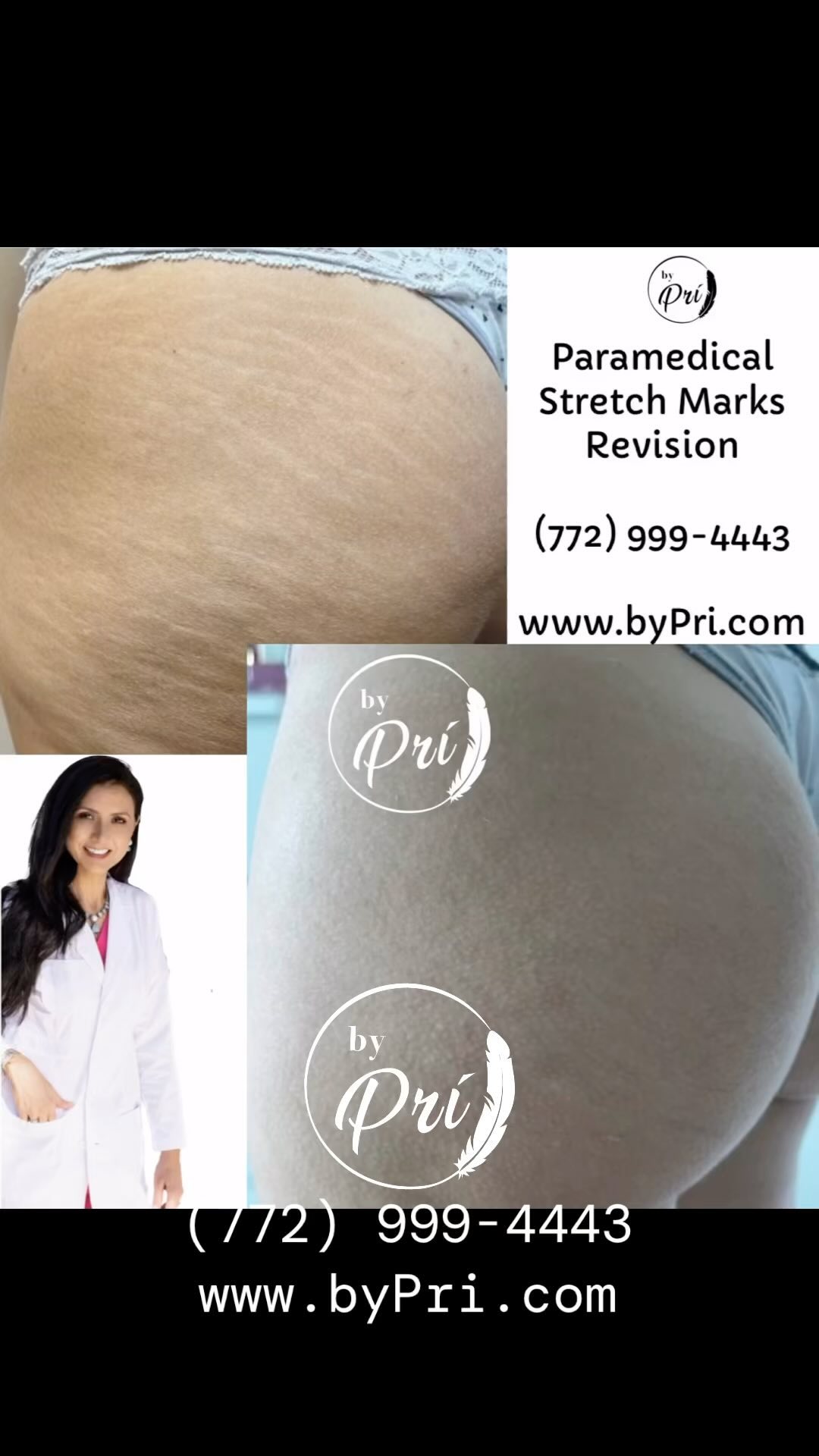 ☎️+1 (772) 999-4443
👉Stretch Marks Revision by Prí
📩 51 Royal Palm Pointe
📫Vero Beach, FL
•⭐️⭐️⭐️⭐️⭐️
•💥Stretch Marks Inkless Treatment @_bypri_
•🔥Permanent Results🔥
Inkless Stretch Marks Treatment.
This treatment reduces the overall size, helps bring back lost pigmentation, and improves the texture of your unwanted stretch marks. #strechmarksrevisionbyPri #camouflagetattoobyPri #tattooverobeach #paramedicaltattoosbyPri #medicaltattooverbeqch #Microblading #stretchmarkcamouflageverobeqxh #stretchmarks #stretchmarksfl #stretchmarkbyPri #stretchmarkremovalvero #stretchmarknomore #stretchmarksbegone #stretchmarktreatment #stretchmarktattoo #stretchmarksremoval #brows #stretchmarksolution #stretchmarktattoo #fortpierce #sebastian #verobeach #vero #Melvour #Ny #fl