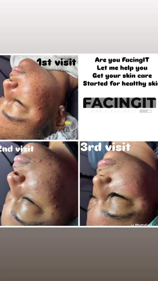 Hello! 👋🏽 My name is Aubria, and I would LOVE to be your esthetician!
I specialize in facial care and provide services that will have you coming back for more.
Did you know your skin has three layers and sheds thousands of skin cells every minute? Keeping your face clean, healthy, and smooth takes work—and finding the right products for your skin type can be overwhelming. But that’s exactly what I’m here for! 😁
Book a session with me and drift into a deep, relaxing sleep while your skin gets the rejuvenation it deserves.
✨ Check out my work and services at 👉🏽 aubriaFacingIT.com
📸 Follow me on Instagram: @_FacingIt
#facials #bodysculpting #skintightening #beauty #atlanta #laserlipo #facialsatlanta #bodygoals #cavitation #noninvasive #clarkatlanta #lipo #postoptreatment #cardi #facingit #coolsculpting #thingstodoinatlanta #woodtherapy #atlantahairstylist #radiofrequency #facialatlanta #lasorlipo #nonsurgical #vacuumtherapy #explorepage #postop #spa #atlantaga #collegepark #bodycontouringatlanta