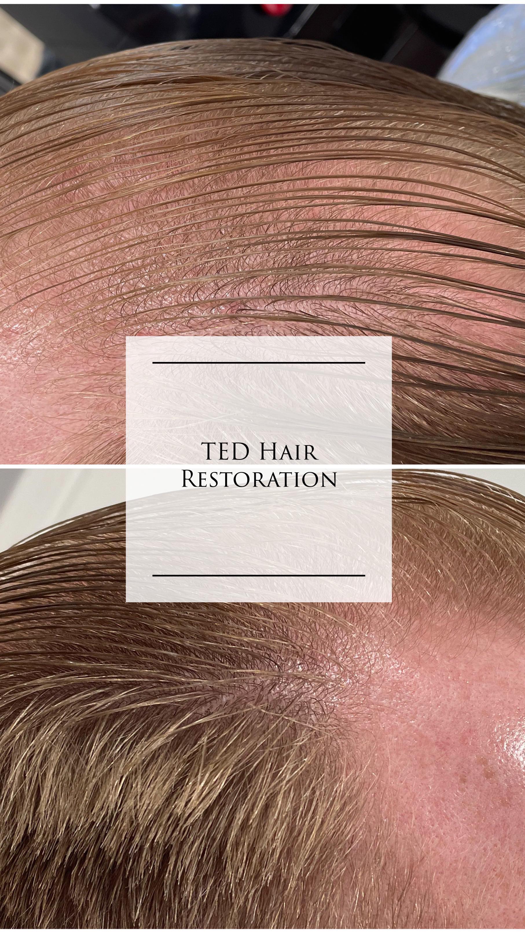 Hair restoration progress after 3 TED treatments, spaced 4 weeks apart! 👏🏻👏🏻
His hair is visibly thicker and stronger with so much new growth still coming it.
💥NO PAIN
💥NO downtime
#almated #almalasers #alma #hairrestoration #indyhair
