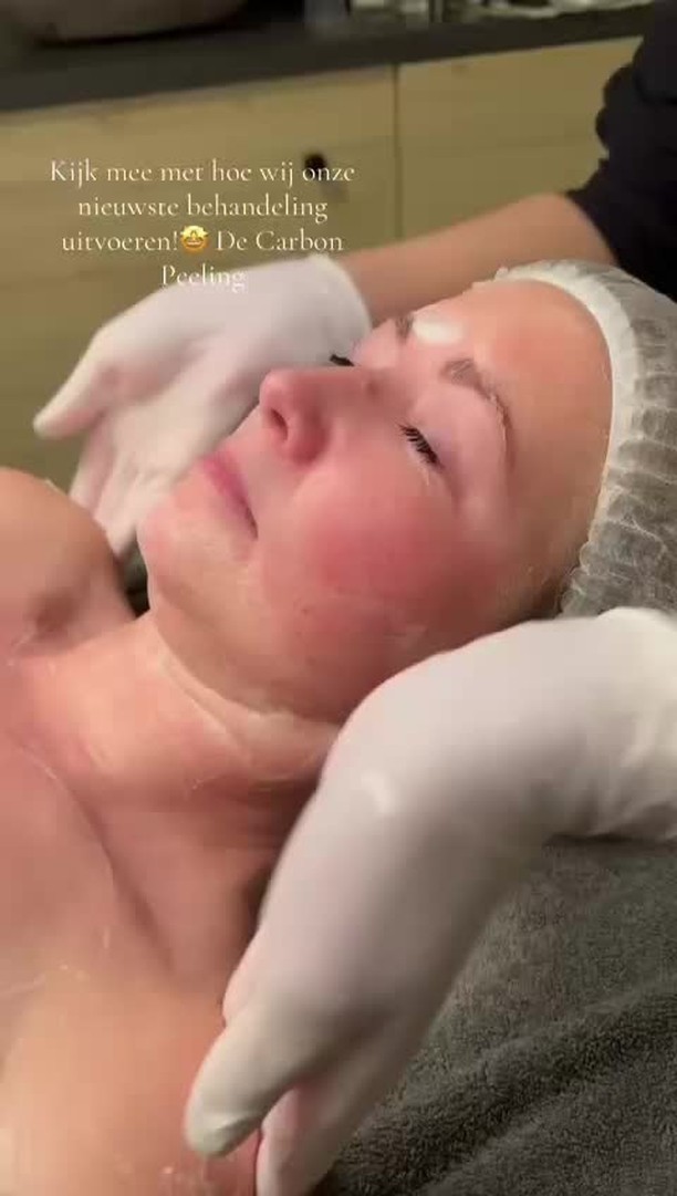 De Carbonpeeling i.c.m. onze Picolaser!
De medicinale koolstof trekt diep in je poriën en huid. De Picolaser reageert met de koolstofdeeltjes en het resultaat is echt prachtig!
* Het reinigt je huid heel diep.
* Het verminderd zichtbaar fijne lijntjes
* Het vermindert grove poriën en littekens
* Verfijnd de huidstructuur.
* Couperose en pigmentvlekken nemen af
* Stimuleert collageen en elastine
* Je huid is zichtbaar strakker en heerlijk zacht!
Nu ter introductie €99,95
Bel of boek online op:
www.schoonheidssalonwilmameins
#schoonheidssalonwilmameins #centrumveendam #langmairpicolaser #carbonpeeling #liefzijnvoorjehuid