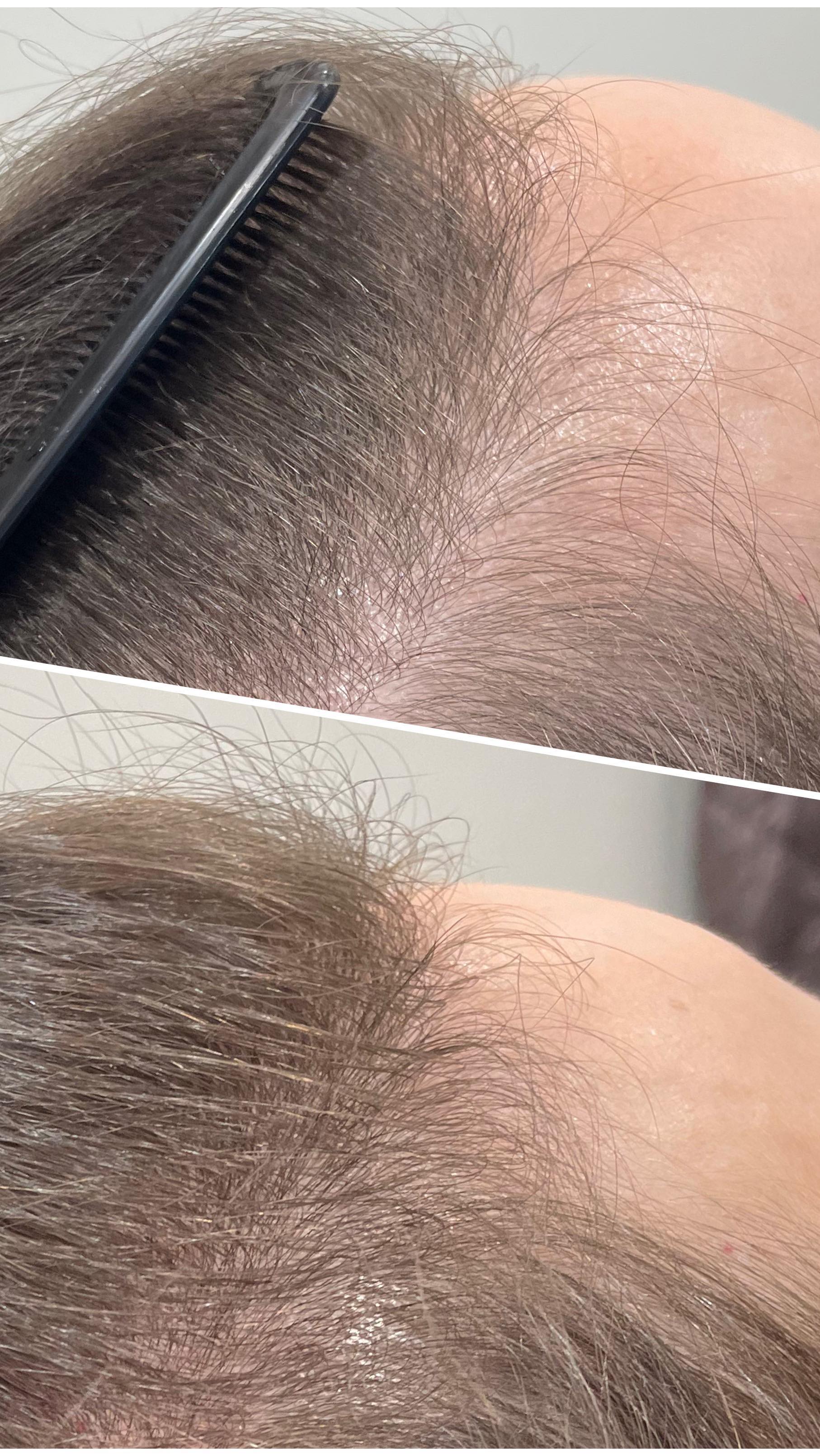 This is insane growth after just 2 hair restoration treatments ๐ฒ๐
Treatment takes about 30 minutes and did I mention COMPLETELY PAINLESS. ๐๐ป๐๐ป๐๐ป๐๐ป๐๐ป
#hairrestoration #hairgrowth #almalasersnorthamerica #almated
