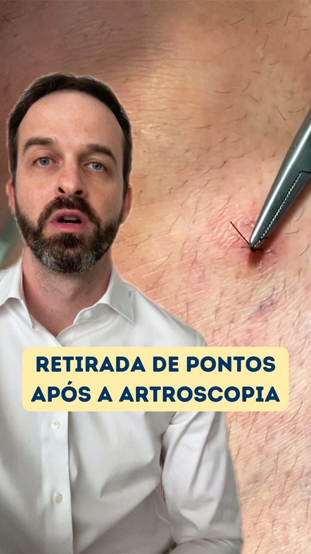 🪡Retirada de pontos ap