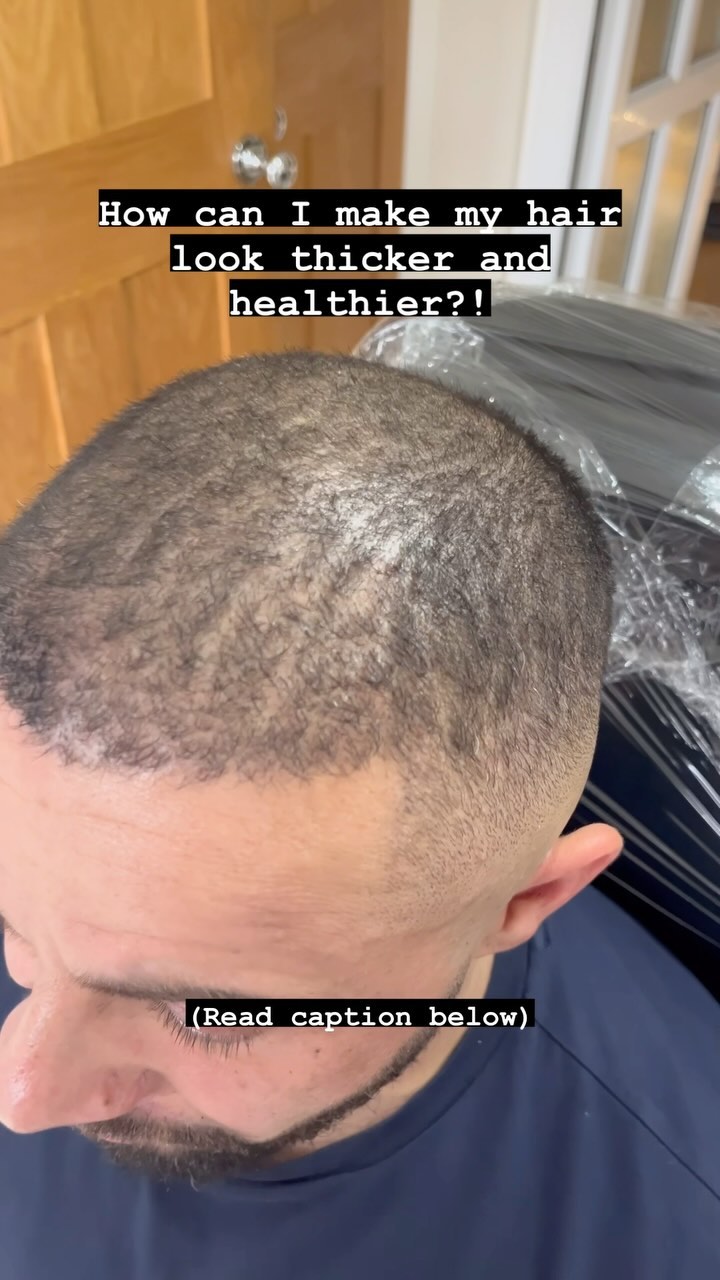 SCALP MICRO-PIGMENTATION (SMP) DENSITY TREATMENT
Thickening up clients hair post #hairtransplant with #scalpmicropigmentation
Its not a choice between SMP and hair transplant, why not use both!
Most transplants I have seen, other than professional footballers, usually need a bit extra density to help achieve the sought after final result, SMP can make hair look so much fuller!
Also, often ‘scarless’ transplants often leave hundreds of white dot scars at the donor area, SMP is an unsurpassed treatment for #scarcamoflauge (more photos to come)
Get in touch with us today to see how Scalp Micro-Pigmentation (SMP) can help you put a stop to hair loss
🕸www.skinheadsmp.co.uk
💻skinheadsmp@gmail.com
📍Bury St Ed’s, Suffolk & Brighton clinics, UK
⭐️5 star Google reviews
💯Customer satisfaction
Recommended by barbers, hairdressers, tattoo artists and more in local areas
Specialists in Scalp Micropigmentation
#smp #hairloss #scalptattoo #hairtattoo #micropigmentation #hairlosstreatment #hairlosssolution #hairtransplant #alopecia #hairgoals #scalppigmentation #hairlinetattoo #hairline #thinninghair #hairgrowth #tattoo #hairregrowth #hair #bald #hairtransformation #hairlosshelp #cosmetictattoo #hairrestoration #menshair #barber #scalptattooing #scalptreatment