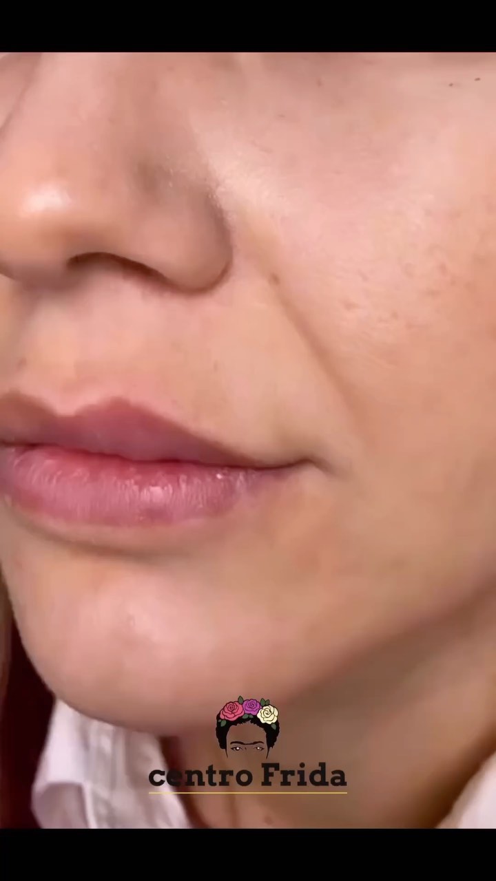 Este verano, atrévete a resaltar tu belleza de forma sutil y elegante con nuestros tratamientos de aumento de labios sin agujas. ¡Siéntete segura y radiante en Centro Frida!
Contáctanos hoy mismo para conocer nuestra promo especial 😉
Centro Frida 🌸🌺🌼
Estética & Belleza
Whatsaap 📲624252194
••••••••••••••••••••••••
#plasmapenmadrid #dermapenmadrid #esteticamadrid #microblading #microbladingmadrid #aumentolabiossinagujas