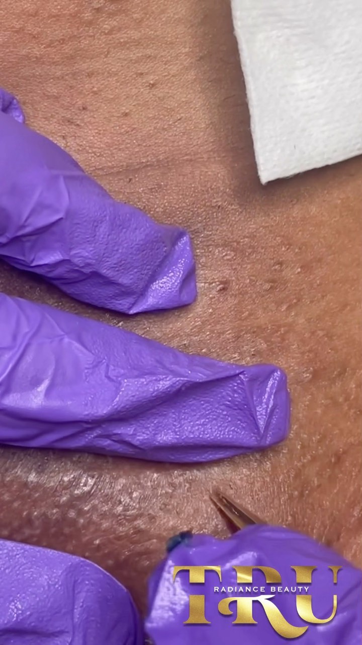 My eye for ingrowns is crazy ! Pulled so many out that was barely visible tucked underneath the skin. Haven’t seen this client in a while so had to do some thorough tweezing but that god I love doing it 🥰 #cincinnatibrazilianwax #cincinnatiwaxing #brazilianwax #waxingspecialist #ingrownhair #ingrownhairremoval #brazilianingrownhairs #cloggedpores #blackheadextraction #extractions #extractionsatisfaction #oddlysatisfying