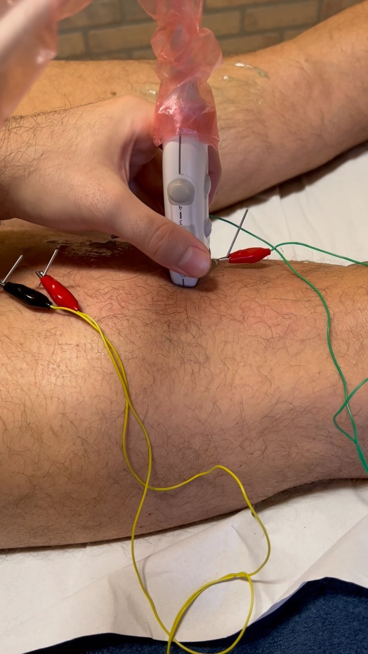 La posibilidad de observar en directo cómo afectan nuestros tratamientos al cuerpo es algo que solo podemos conseguir con el uso de la ecografía músculoesquelética y que es característico en nuestro servicio.
Sin duda, esto nos ofrece la posibilidad de:
✅ Asegurarnos que estamos trabajando el tejido diana/objetivo
✅ Observar y comprender cómo afecta la terapia propuesta
✅ Controlar dentro de la sesión y en las consecutivas, que la evolución es la correcta
🚨 Saber cuando NO debemos intervenir y es más importante derivar el caso a otro profesional
#ecografíamusculoesquelética #lesionesdeportivas #rehabilitacion #fisioterapia #fisioterapiadeportiva♥