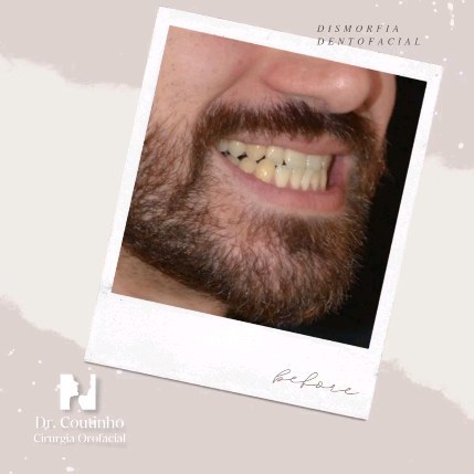 Apresentamos um caso de prognatismo mandibular causado por hipoplasia da maxila, tratado com cirurgia ortognática e ortodontia com alinhadores invisíveis.
Este resultado fantástico destaca a importância do planeamento virtual da cirurgia ortofacial e da ortodontia.
A precisão do planeamento digital não só garante resultados estéticos e funcionais superiores, mas também permite a utilização de técnicas minimamente invasivas, reduzindo o tempo de recuperação e melhorando a experiência do paciente.
Cada sorriso que transformamos é um testemunho do poder da tecnologia aliada à medicina. #transformaçãodosorriso
#cirurgiaortognatica
#cirurgiaortofacial
#ortodontiainvisivel