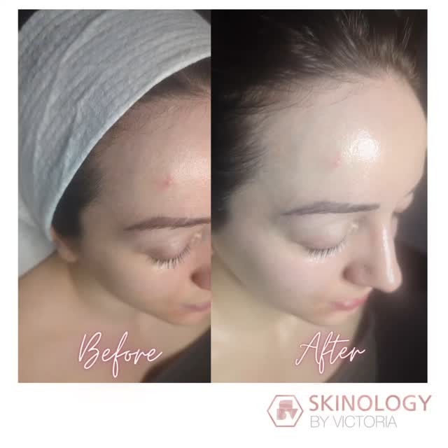 Before and afters are one of the best parts of my job 😍 check out my beautiful clients amazing glowing skin ✨