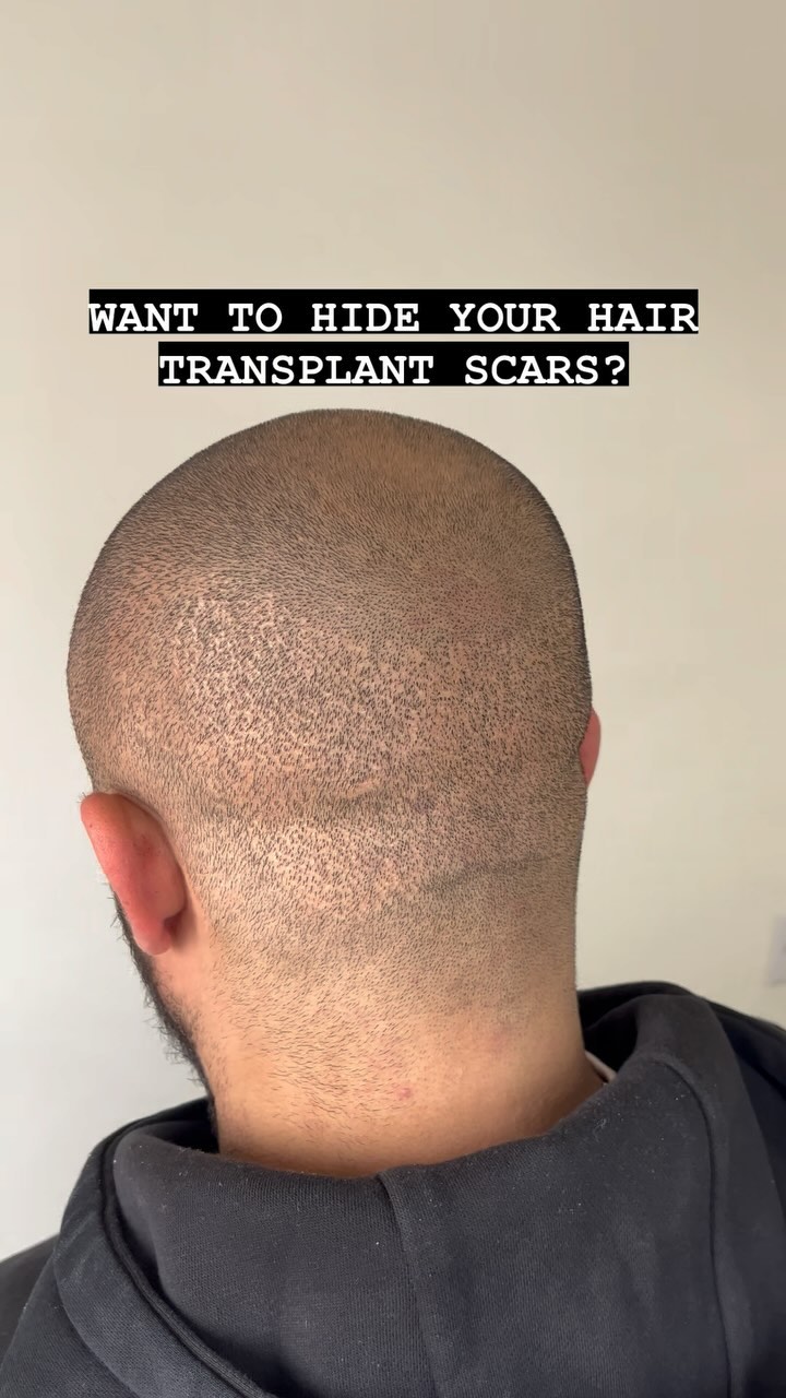 TRANSPLANT SCARS
This is an aftermath of a ‘scarless transplant’!
This is why often people after a FUE hair transplant they keep the back of their hair longer, however, if you were to want a skin fade, you will see little dot scars.
With scalp micro-pigmentation (SMP) we can help strategically place pigments into the dots to help conceal the brightness of the scar and create a full head of hair at the back again
📍Suffolk & Brighton, UK
🕸️www.skinheadsmp.co.uk
#scarcoveruptattoo #scarcoverup #scartreatment #fuehairtransplant #transplantscar #hairtransplant #scarremoval #scarcamouflage
Machine: Kwadron
Cartridges: FYT
Pigment: Ghost 👻