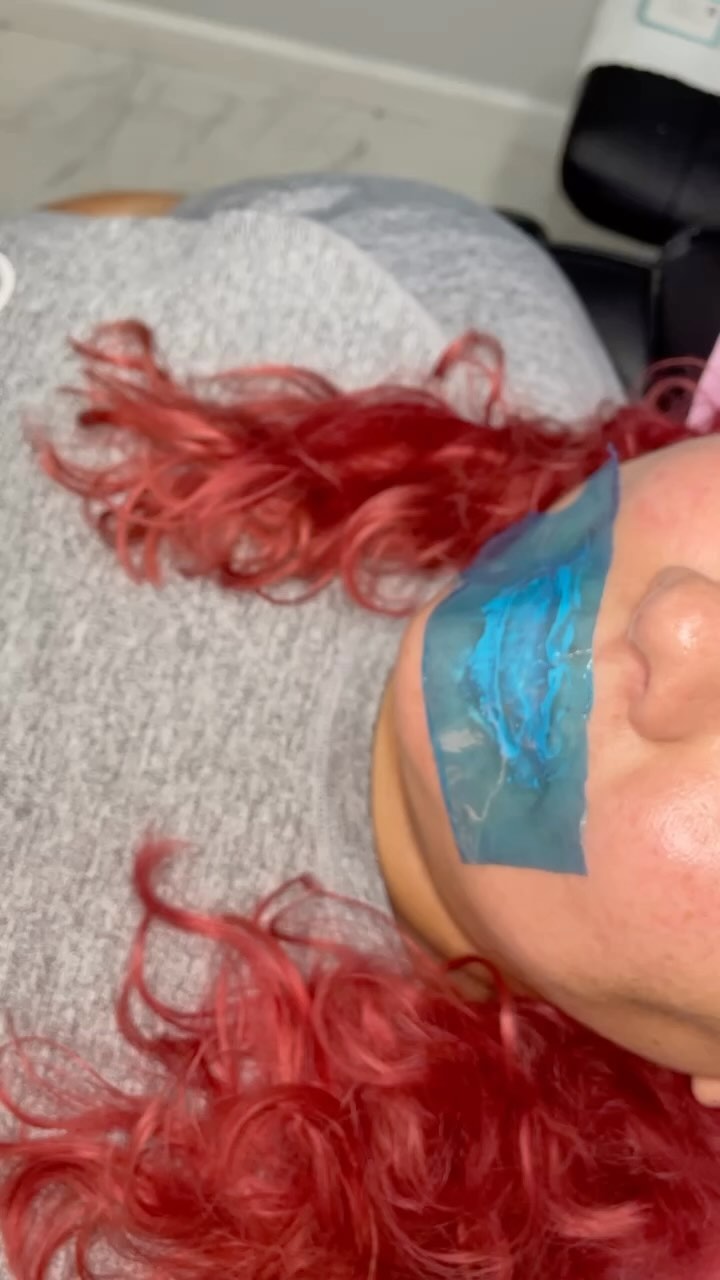 1mL syringe was used. Using my Combination injection method w/ Hyaluron Pen + Microneedle 💉. Lasts 10-14 months. Touch up recommended @ 6-8months. #hyaluronpen #hyaluronpentraining #tampalips #tampafiller #lipfiller #lipinjections #facialbalancing #lipshaping #microneedling #dermalfiller #bradentonlipfillers #sarasotalipfiller #orlandolipfiller #lashextensions #tampalashes