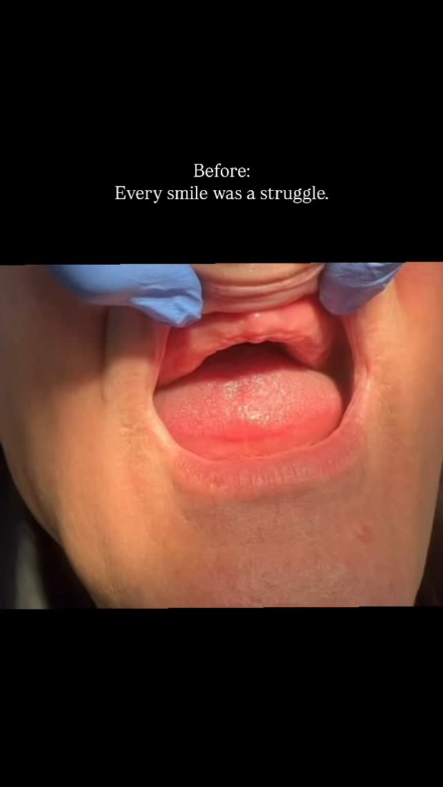 Before and after 💫
Dr Rose 👏 @dr.rosepasha
#dentistry #dentist #dentalclinic #dentistlondon #teeth #teethcare #dentures #denture #northlondon #nhs #nhsdentist #dentalclinic #woodgreen #beforeandafter #fyp #foryour