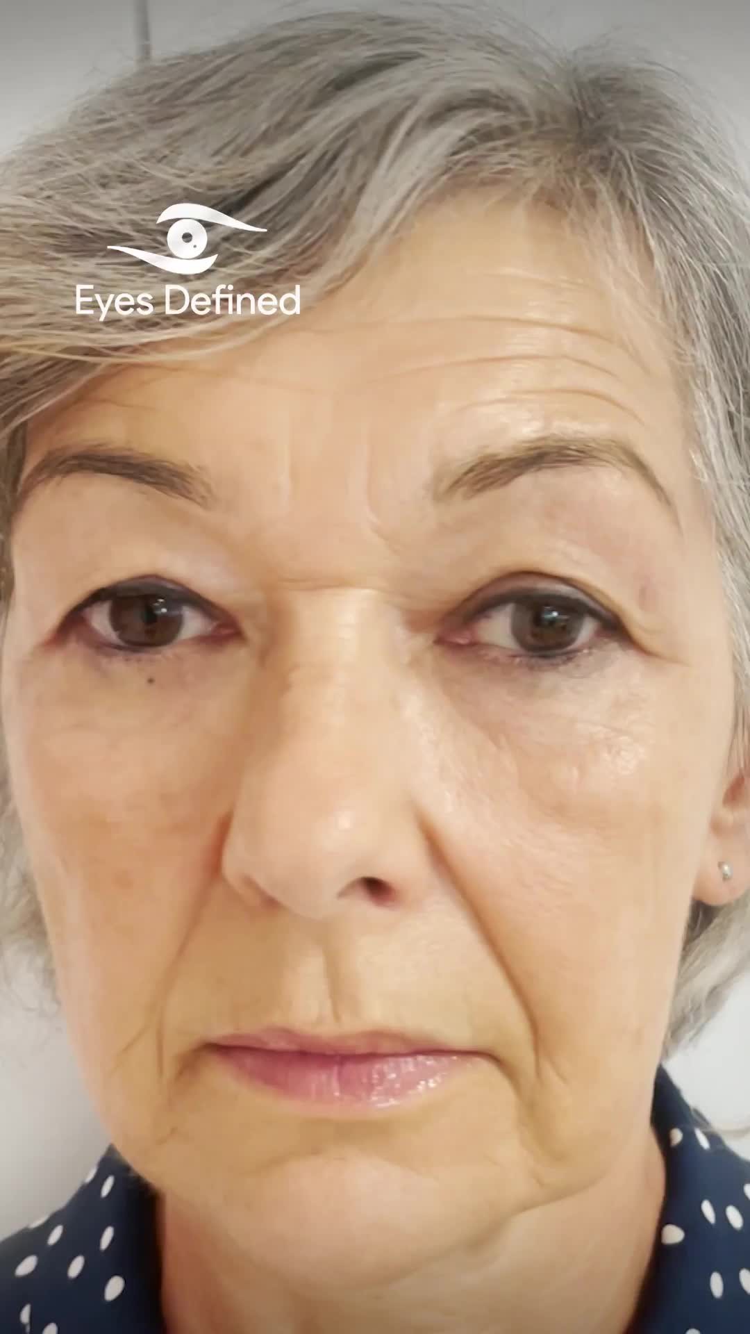 ✨ Just one week post-upper eyelid blepharoplasty an starting to see the results! ✨ The excess skin is gone, and the eyelids can show again. Swelling will settle with time 👁️💖 If you've been considering this procedure, don't hesitate to reach out for more info or to share your own experiences! Let's chat in the comments! 💬👇 #Blepharoplasty #EyelidSurgery #FreshLook #SelfCareJourney #PlasticSurgeryBeforeAndAfter