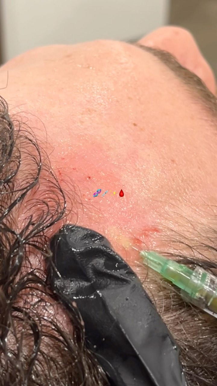 PRP Hair Restoration π§¬πβ¨π©Έ
β’
#hairloss #hairtransformation #balding #baldingsolution #prp #prphairrestoration #urbanlistsc