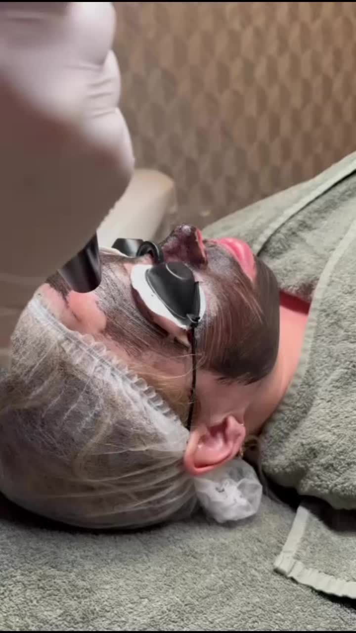 De carbonpeeling met de Picolaser! De hele maand mei nog voor de introductieprijs van €99,95 (i.p.v. €119,95). Direct een rustigere, strakkere huid met een prachtige glow!