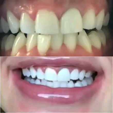 ERBJUDANDE 995 KR När ni bokar för 2 personer. Priset gäller per person (DUO BEHANDLING)(Ordinarie pris 4900 kr) 
ONLINE TIDSBOKNING
www.DentalClinicSweden.org🔺️
 #tandblekningstockholm #TandblekningStockholm #stockholm #liljeholmen #KlinikTandblekning #TandblekningGöteborg #TandblekningUppsala #TandblekningUtbildning #fillers #fillersstockholm #fillersgöteborg #fillersmalmö #TandblekningsUtbildning