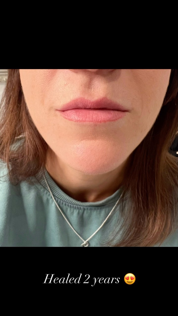 LIP TINT 🤍 2 years on and still looking so beautiful. From lifeless and pale lips to fuller looking, healthier lips. Stunning!