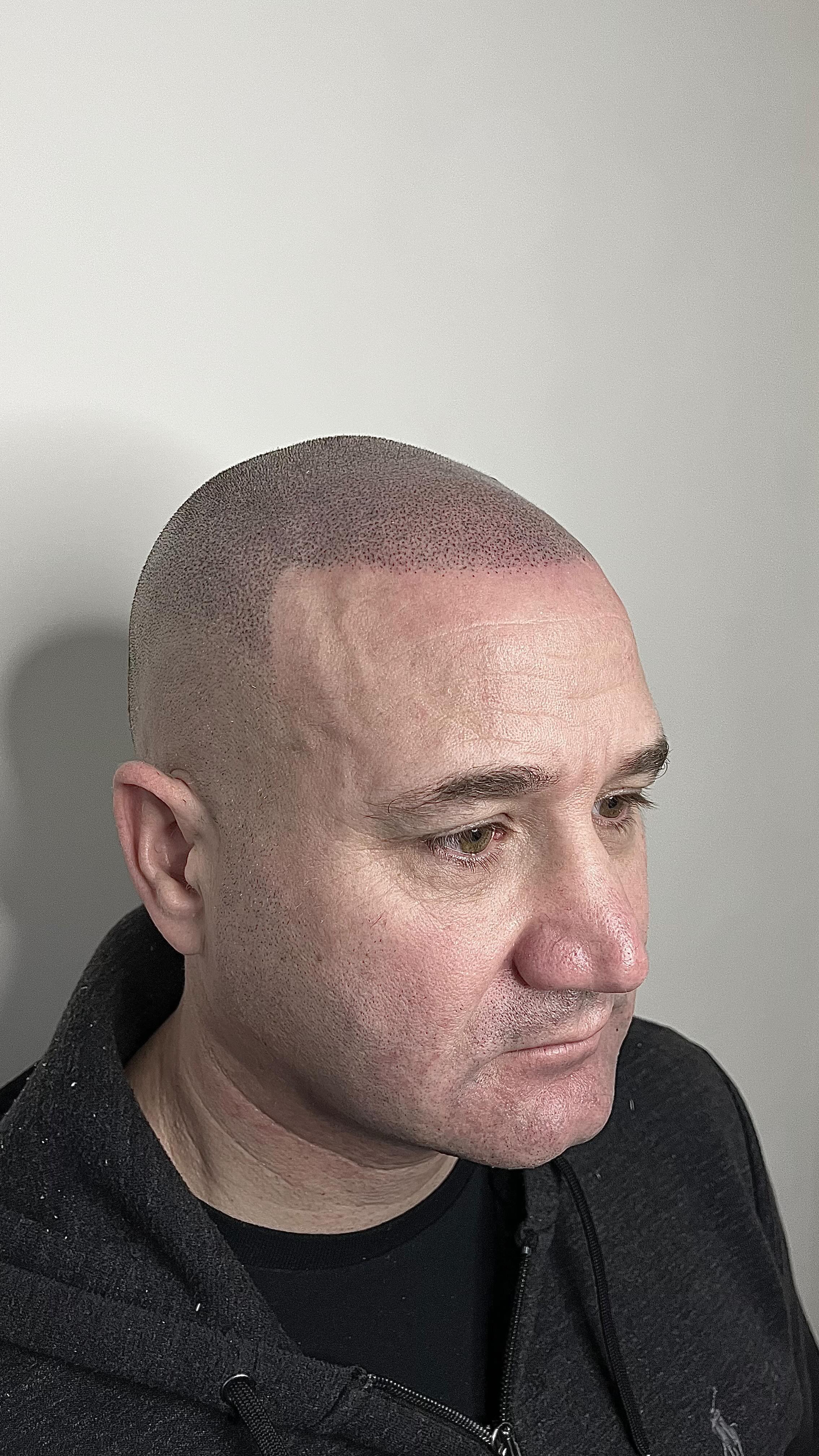 SOLVE HAIRLOSS
SMP is the best cure for hairloss on the market today! FACTS
NO SURGERY
NO MEDICATION
RESULTS FROM FIRST SESSION
Send a DM to get a quote today
🕸www.skinheadsmp.co.uk
💻skinheadsmp@gmail.com
📍Bury St Ed’s, Suffolk & Brighton clinics, UK
⭐️5 star Google reviews
💯Customer satisfaction
#smp #hairloss #scalptattoo #hairtattoo #micropigmentation #hairlosstreatment #hairlosssolution #hairtransplant #alopecia #hairgoals #scalppigmentation #hairlinetattoo #hairline #thinninghair #scalp #hairgrowth #tattoo