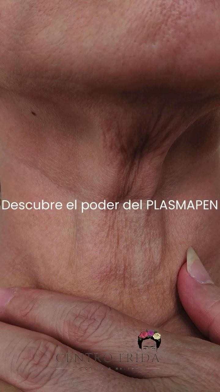 ¿Te gustaría mejorar la zona del cuello y papada?
Plasmapen es la solución 👌
Con este tratamiento en cuello y papada eliminamos piel sobrante (una o varias sesiones) y por el efecto de termocontracción también va a estimular la regeneración del colageno de forma natural, consiguiendo tensar la piel y produciendo un efecto lifting.
¡Escríbenos para más información! 🤗
Centro Frida 🌸🌺🌼
Estética & Belleza
Whatsaap 📲624252194
••••••••••••••••••••••••
#plasmapenmadrid #dermapenmadrid #esteticamadrid