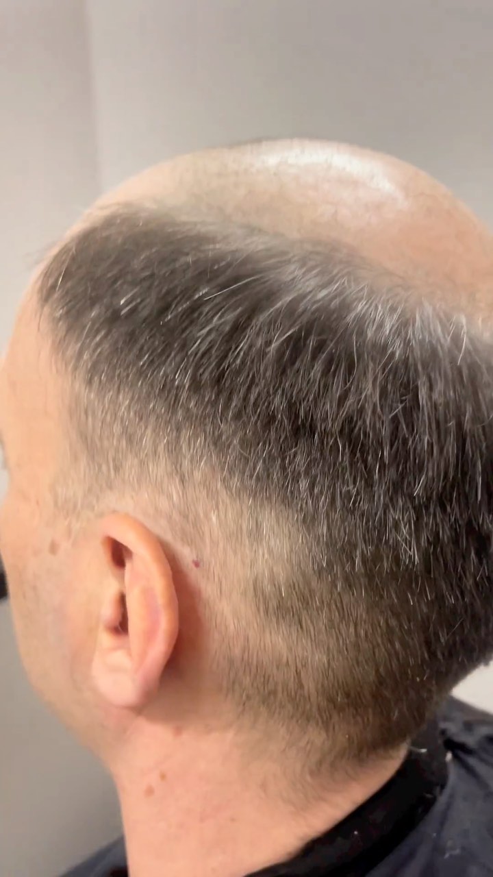 🎉 Amazing Transformation! Boosting Confidence with Custom Hair Replacement Systems! 🌟
Hey, Sydney! We’ve got something truly mind-blowing to share with you today, courtesy of the incredible @carlthomashair here at @thehavensydney! Prepare to be amazed by this remarkable before and after transformation featuring a brand new, custom hair replacement system. 🙌
🔎 Seeking a Solution for Hair Loss? Look No Further! 👀
Let’s face it: hair loss can be a challenging experience, affecting both men and women. It can shake our self-confidence and make us feel self-conscious about our appearance. But fear not, because we are here to change the game and empower you with a hair replacement solution that’s tailored just for you! 💪
💇♂️ Hair Replacement Services: The Ultimate Confidence Booster! 💇♀️
We understand the impact hair loss can have on your life. With their state-of-the-art hair replacement services, we have helped countless individuals regain their confidence and love their reflection in the mirror once again! 💕
✨ Say Goodbye to Hair Loss Worries and Hello to a New You! ✨
Imagine a life where you no longer worry about thinning hair or receding hairlines. With our expertise and the personalised hair replacement systems available, that dream becomes a reality! ✨
If you’re searching for a solution to hair loss in Sydney, look no further! We offer the best hair replacement services for men and women. Our custom hair replacement systems are designed to tackle hair loss head-on, restoring your natural look and giving you back your confidence. Say goodbye to hair loss and hello to a new chapter of your life, filled with self-assurance and happiness! 💥
💥 Transforming Lives, One Head at a Time! 💥
Don’t let hair loss define you! Take charge of your appearance and embrace a new level of self-assurance with us. Witness the incredible work of in this reel and be inspired to explore the possibilities of a custom hair replacement system for yourself or your loved ones!