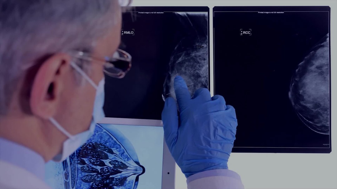 Post-mastectomy journeys can often lead to the onset of lymphedema, a condition marked by swelling due to lymphatic system disruption. Early symptoms, including swelling, heaviness, and tightness in the limbs, signal the need for prompt attention. Traditional Chinese Medicine offers holistic approaches—such as herbal remedies, acupuncture, and Qi Gong exercises—to enhance circulation and alleviate swelling naturally. Embrace the healing power of these time-honored practices. Follow Health Traditional Medicine for expert insights on Chinese treatments and health tips!
#LymphedemaAwareness #PostMastectomyCare #TraditionalChineseMedicine #HolisticHealing #TCMPractices #AcupunctureHealing #HerbalRemedies #QiGong #NaturalHealing