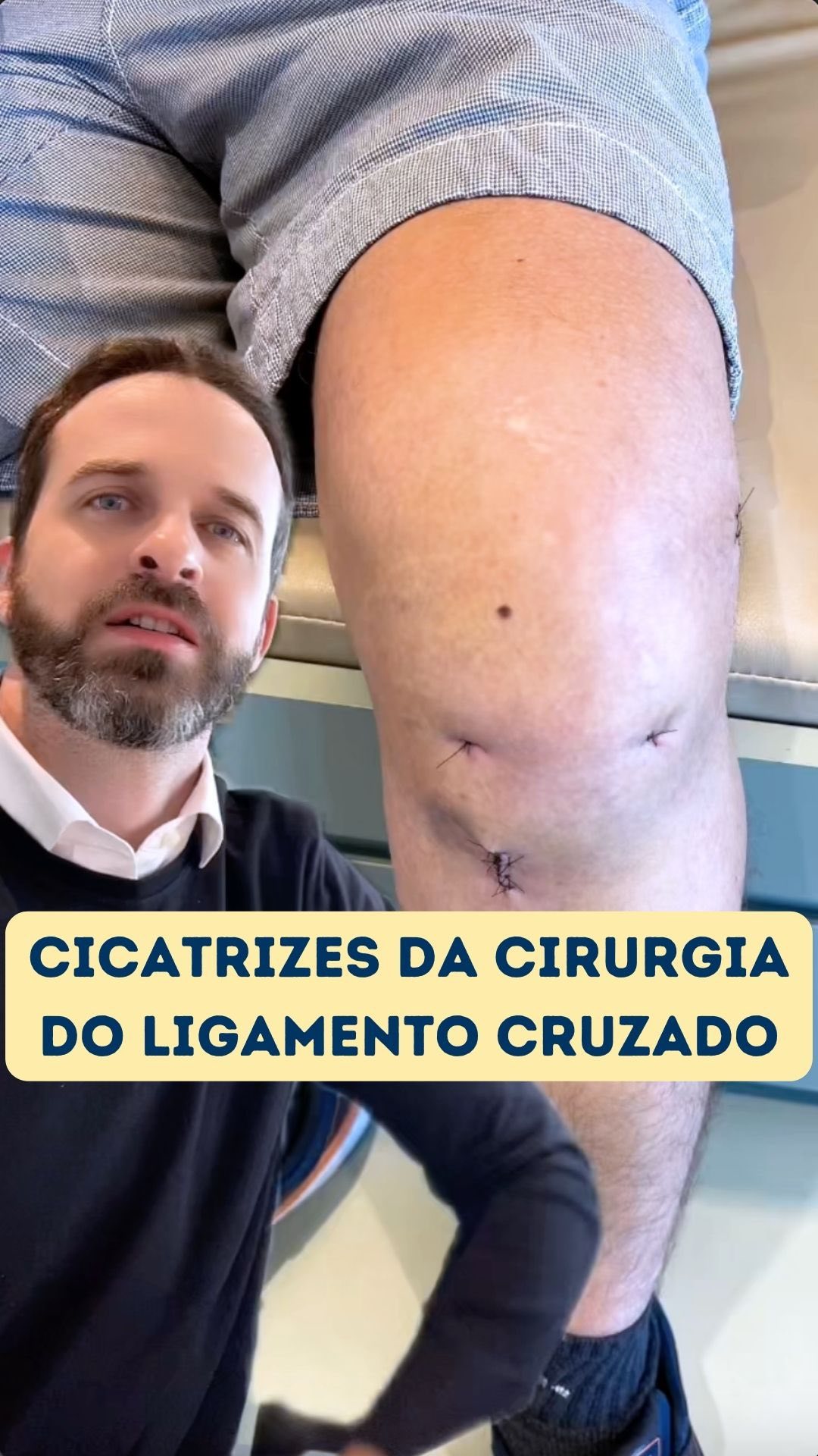 🩹Cicatrizes após a cirurgia de reconstrução do ligamento cruzado anterior do joelho com tendões flexores. É importante saber que as incisões cirúrgicas podem variar de acordo com a técnica utilizada. #joelho #ligamentocruzadoanterior #cicatriz