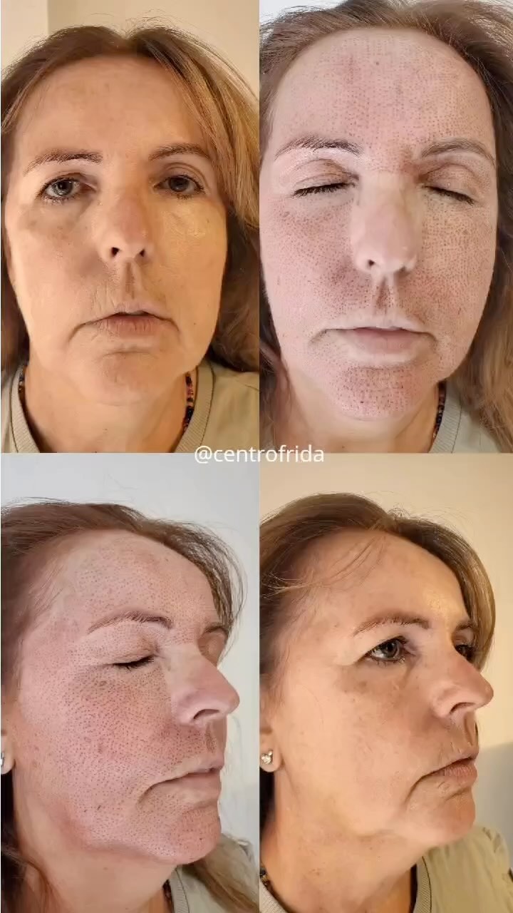 ¿Cuanto tiempo duran los resultados del proceso de plasma fibroblast?
🖊️Los resultados del plasma fibroblast son extraordinarios y duraderos, recordemos que el tiempo sigue su curso⏳ Este tratamiento puede mantener tu piel rejuvenecida por años, el envejecimiento natural continua,, por eso es ideal complementario con buenos cuidados 💆🏻♀️
¿Tienes preguntas sobre el procedimiento de plasma fibroblast? Déjalas en el comentario!👇#plasmafibroblast #plasmapentraining #plasmapen #fibroblasting #fibroblast #faciales #tratamientos #tratamientosfaciales #skincare #centrofrida