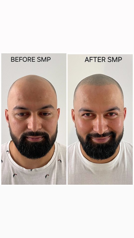 This is your chance to regain your crown!
🔥Tattoo your hairline back with the flawless innovative technique of SMP!
SMP, or Scalp MicroPigmentation, is a non-surgical procedure that creates the illusion of thicker hair by applying super tiny dots of pigmen into your scalp. 
🗓 Book your free consultation at my professional studio in Helsinki 🇫🇮 and reclaim your crown!
🗣At @scalp.fi , we speak EN, FI, RU. Feel free to get in touch at any time.
#smp #scalpmicropigmentation #scalptattoo #hairtattoo  #трихопигментация #micropigmentation 
#balding #hairloss #alopecia
#HairLossTreatment 
#helsinki #Finland #smpfinland