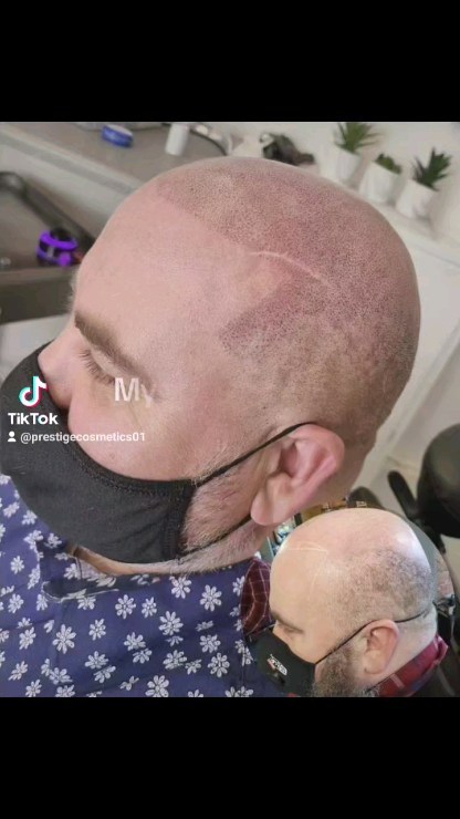 My first client 4 years ago, was in this week for his first touch up ready for the big day next week 💒
I used 3 different size needles, 2 different shades to create this soft 3d finish!
#wirral #wirralbarbers #wirralbusiness #prestigecosmetics #smp #scalpmicropigmentation #scalp #hairloss #hairlosssolution #boldtattoos