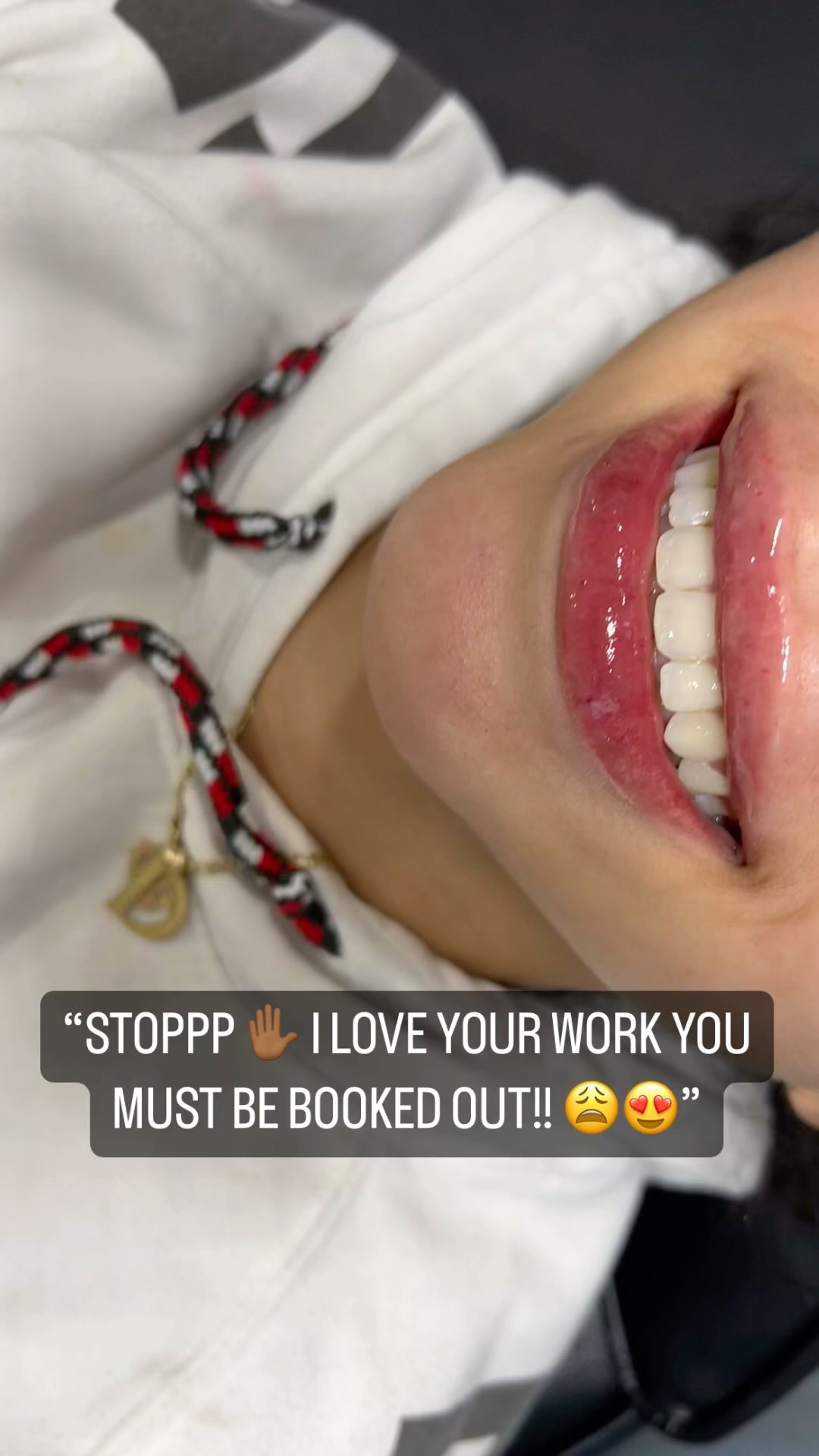 Like follow share comment!! Anything is appreciated ๐ฅน๐๐พ๐ค๐ฝ. #hyaluron #hyaluronpen #tampalips #tampalashes #sarasotalips #lashextensions #lipfillers #microneedling #lipshaping #explore #beauty #facial #hairinspo #nailinspo #lashtech #miamilips #clearwaterlashes #bradentonlashes